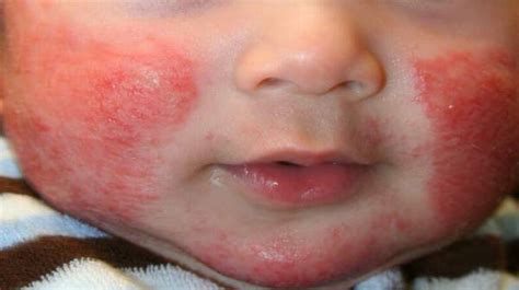 Atopic Eczema Look Like Symptoms Causes And Treatment