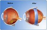 Pictures of Detached Retina Recovery Time