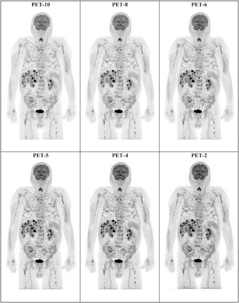 Whole Body Petct Cuts Scan Time In Melanoma Patients