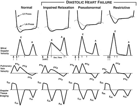 Lv Diastolic Function Echocardiography Iucn Water