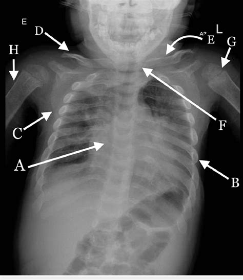 Chest X Ray Ribs Narrowing On The Sternum End A Ribs Widening On The