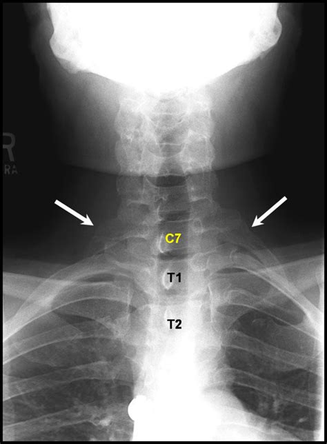 Cervical Ribs At C7 Plain Antero Posterior Radiographs Demonstrate C7