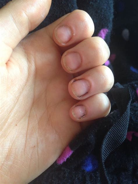 How To Fix And Grow Out Bitten Nails Bc Guides