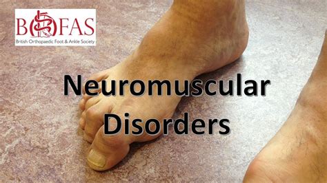 Neuromuscular Disorders Of The Foot And Ankle Youtube