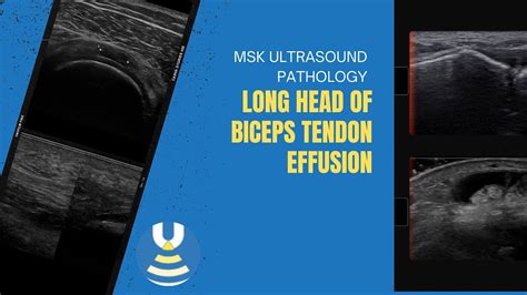 Long Head Of Biceps Tendon Effusion On Ultrasound Youtube