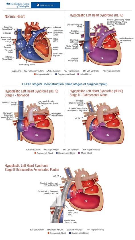 Description Of The 3 Stages Of Repair For A Hypoplastic Left Heart For