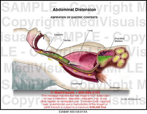 Abdominal Distension Medical Illustration Medivisuals