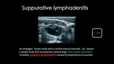 Pin By Dr Abuaiad On Lymphatics Incoming Call Screenshot Ultrasound