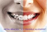 Medicare Braces Teeth Pictures