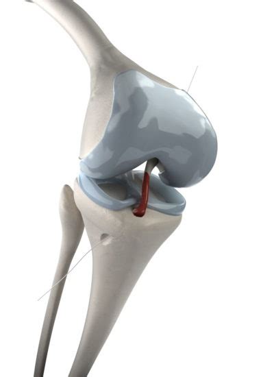 Anterior Cruciate Ligament Acl Injury