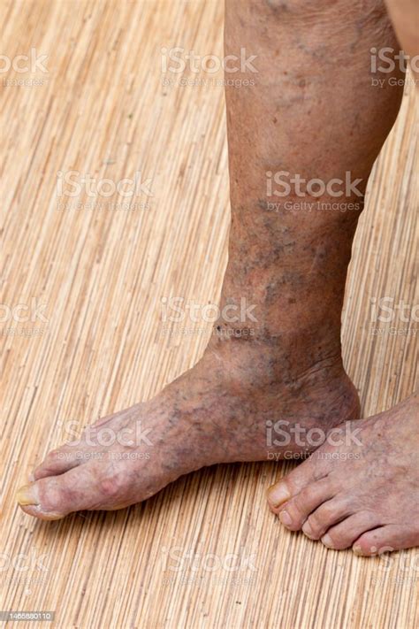 Cropped Senior Woman Bare Legs And Feet With Painful Protruding Spider Varicose Veins
