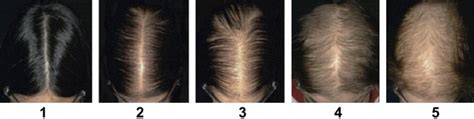How Long Does It Take For Spironolactone To Work For Hair Loss