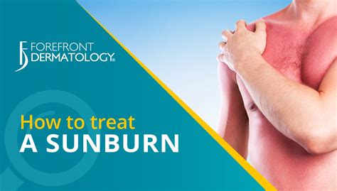 How To Treat Sunburn Forefront Dermatology