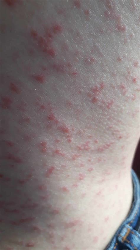 Is Skin Rash A Covid Symptom Allergy Differences