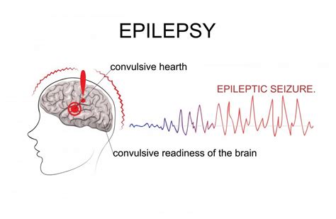 Epilepsy Causes Symptoms And Treatment Greenbhl