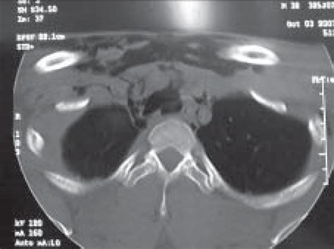 Ct Scan Image Showing Evidence Of Tracheal Injury And Surgical
