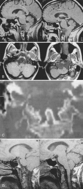 Tumors Of The Craniovertebral Junction Clinical Gate
