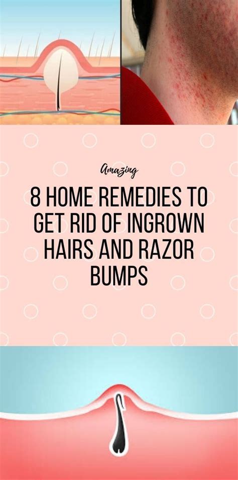 8 Home Remedies To Get Rid Of Ingrown Hairs And Razor Bumpsbumps