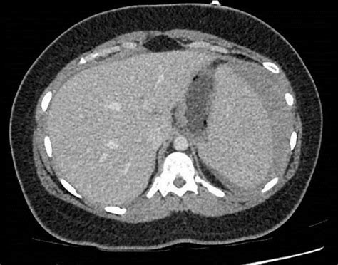 Spontaneous Splenic Rupture In A Patient With Infectious Mononucleosis