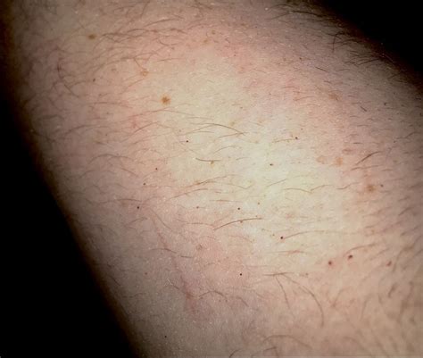 Hundreds Of Tiny Pinprick Pinhead Red Dots On Sk My Skin
