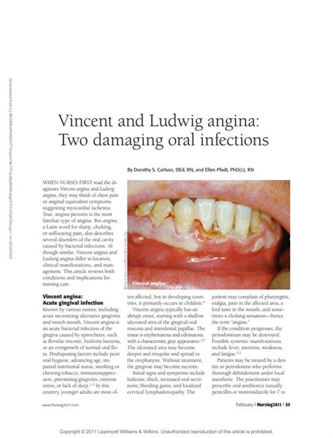 Vincent And Ludwig Angina Two Damaging Oral Infections Nursing2022
