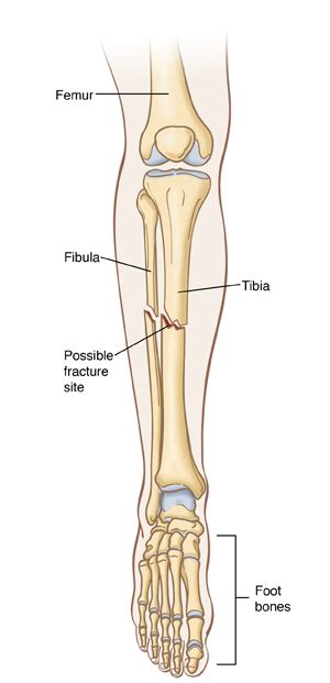 Want to learn more about it? Leg Fracture (Child)