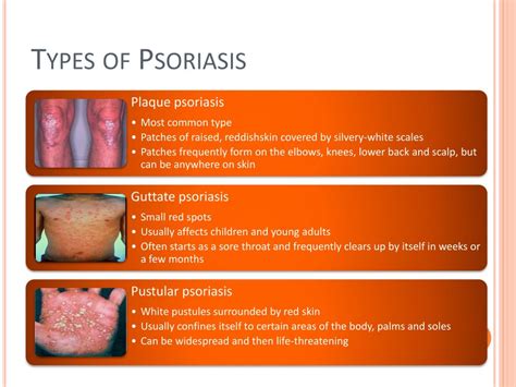 Ppt Acne And Psoriasis Powerpoint Presentation Free Download Id2569650
