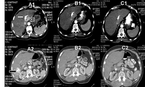 Sequence Of Images Of Contrast Enhanced Abdominal Ct Scan A1 A2