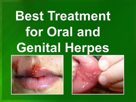 Best Genital Herpes Cure Treatment In Atlanta GA YouTube