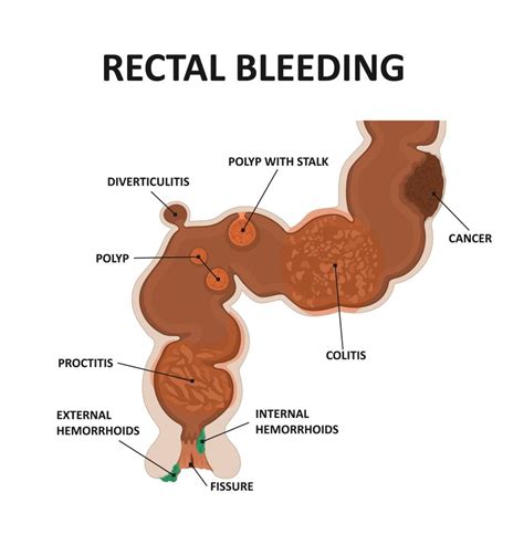 Rectal Bleeding And Bleeding From The Rectum Causes And Diagnosis The