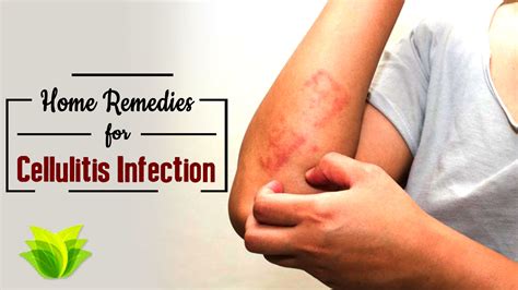 Bacterial Cellulitis Skin Infection