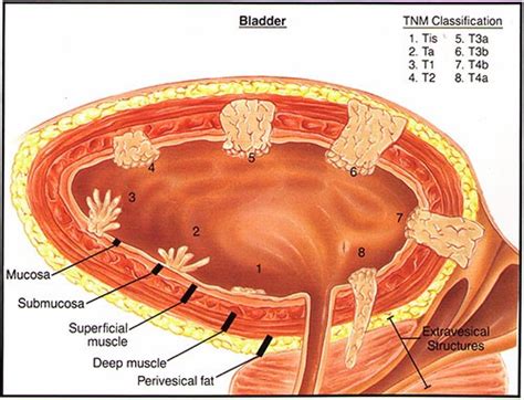 Bladder Cancer Gm Urology