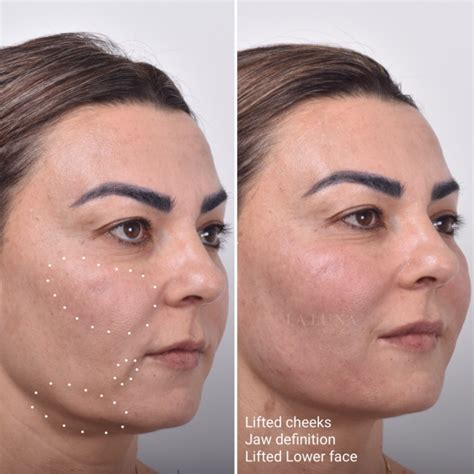 Thread Lift Before And After Mint Lift Photos Michigan Patient