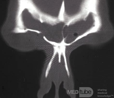 Right Frontal Sinus Fistula Post Trephination Ct Scan • Image