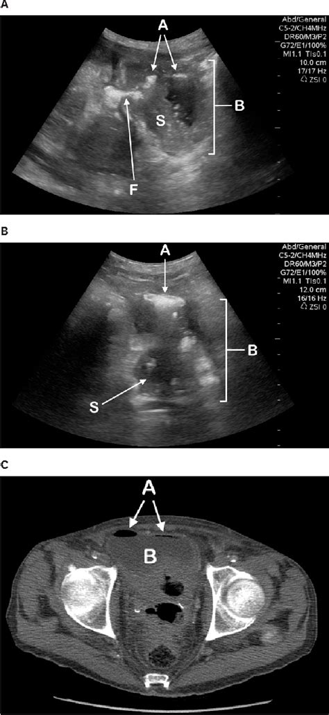 Figure 1 From Point Of Care Sonographic Diagnosis Of An Enterovesical