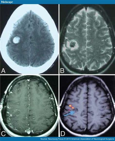 News Pediatric Neurology Epilepsy Sleep Medicine Brain Injury