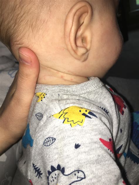What Are These Spotsbumps On My Four Month Old Neck Babies