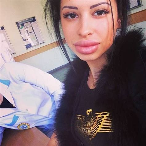 Anya Flaunts Her Massive Fake Lips 21 Pics
