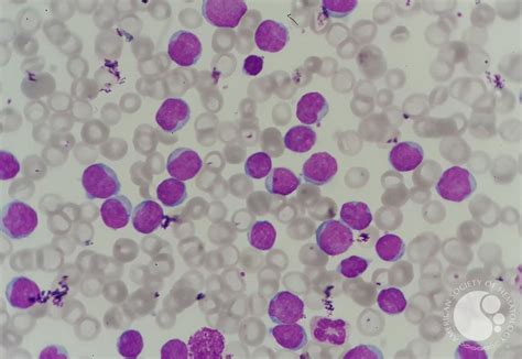 Chronic Lymphocytic Leukemia Cll With Presence Of Pro Lymphocytes 1