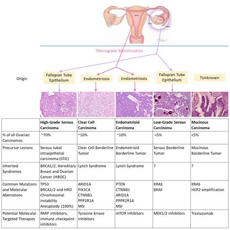 Cancer As Related To Ovarian Low Malignant Potential Tumors Pictures