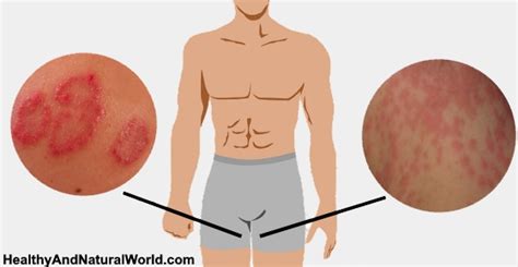 the best natural remedies for tinea cruris jock itch