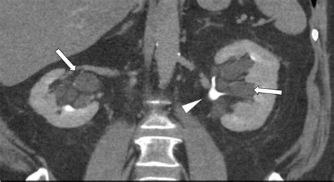 Coronal Contrast Enhanced Ct In The Nephrographic Phase Contrast Is