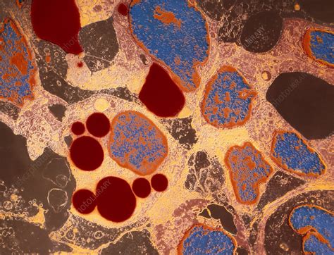 Coloured Tem Of Kaposis Sarcoma A Skin Cancer Stock Image M112