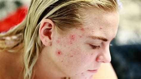 Study Shows Non Antibiotic Treatment For Women With Persistent Acne Is