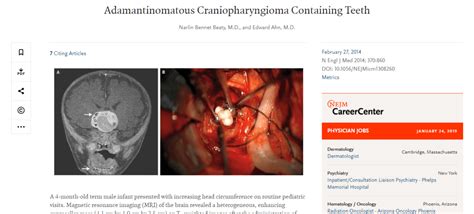 Teratoma Tumor The Demonic Mass That Grows Teeth Eyes Feet And Organs Gnostic Warrior By