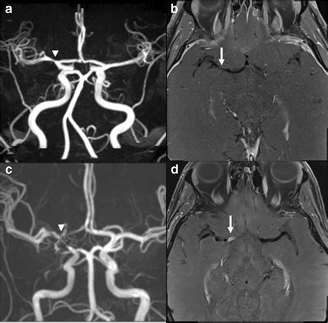 Mra And Hr Mri Post Gadolinium Contrast In Rcvs And Cns V Patients A