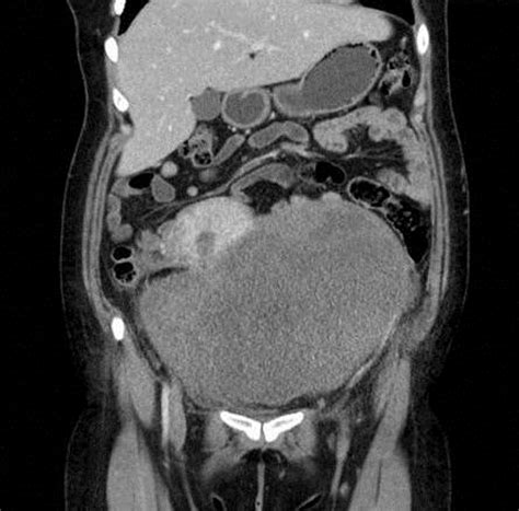 Abdominal Computed Axial Tomography With Contrast Medium Showing A