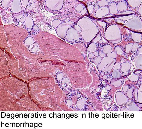 Pathology Outlines Multinodular Goiter