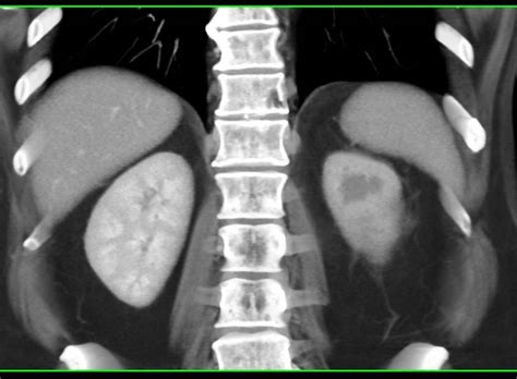 Bladder Cancer Obstructs The Left Ureter Genitourinary Case Studies