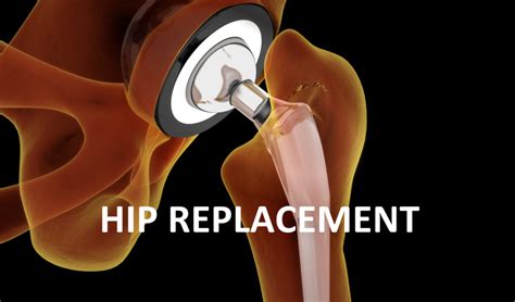 Hip Replacement Surgery Buckinghamshire
